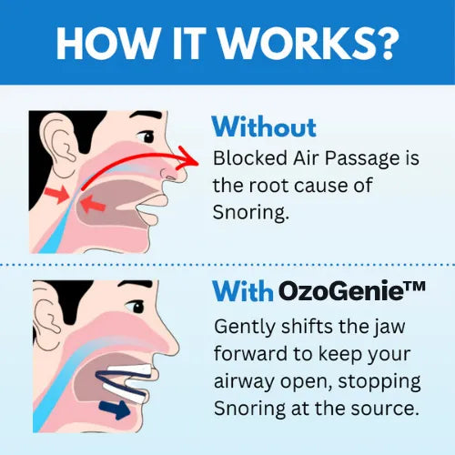 OzoGenie™ Anti-Snoring MouthPiece